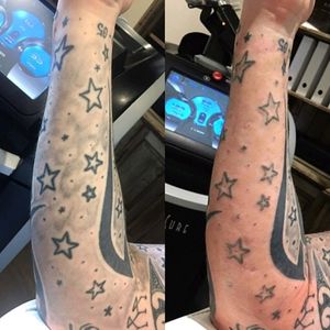 Picosure tattoo removal, 1st sitting shading gone....