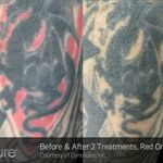 Red only 2 treatments