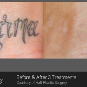 3 X treatments with Picosure...Wrist tattoo ..