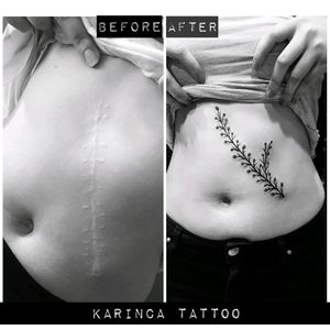 Scar Cover Tattoo 🌿 Instagram: @karincatattoo #scar #scartattoo #covertattoo #coverup Instagram: @karincatattoo #side #tattoo #black #tattoos #inked #inkedgirls #dövme #istanbul #tattooer #tattooartist #tattooidea #smalltattoo #minimaltattoo #little #tatted #tattooed #woman #girls #tattooforgirls #stomach