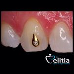 Beautiful gold and diamond Dental Jewelry by Elitia #Dental #Tooth #Piercing #BodyModification #Elitia