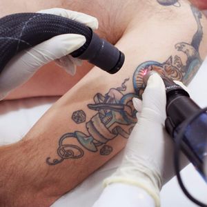 Um dos métodos de remoção de tattoos com laser. #laser #remoçãodetatuagem #saúde #dermatologia #cuidados #LaserRemoval