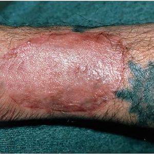 Enxerto de pele após reação alérgica do paciente! #laser #remoçãodetatuagem #saúde #dermatologia #cuidados #LaserRemoval