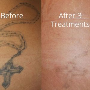 Até tatuagens porcamente feitas por curiosos são difíceis de sumir. Essa daí passou por 3 sessões. #laser #remoçãodetatuagem #saúde #dermatologia #cuidados #LaserRemoval