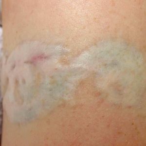 Cicatriz após remoção não profissional. #laser #remoçãodetatuagem #saúde #dermatologia #cuidados #LaserRemoval