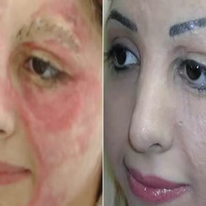 Before and after shot of Basma Hameed's cosmetic tattooing of her own face.  #BasmaHameed #cosmetic #facialtattoos #lifechanging #paramedical