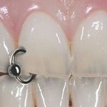 Dental piercing sample #Dental #Tooth #Piercing #BodyModification