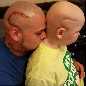 Matching scar tattoo #headtattoo #cancer