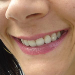 Bright and nice smile with a dental piercing #Dental #Tooth #Piercing #BodyModification