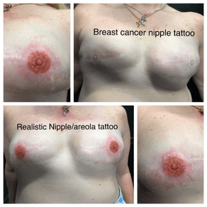 Some realistic nipples for a cancer survivor after very many surgeries. 