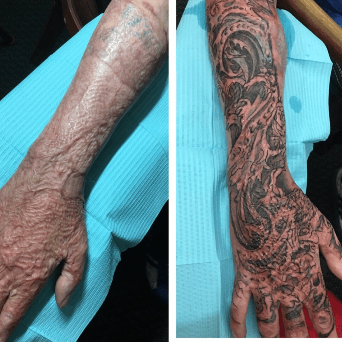 Tattoo artist conceals burn scars