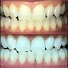 Pearlsmile teeth whitening/tattoo laser removal