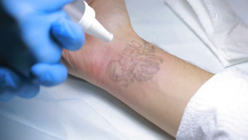Laser treatment breaks apart ink particles so they are easier for your immune system’s cells to break down.