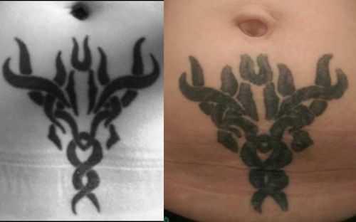 Tattoo geometry before and after pregnancy